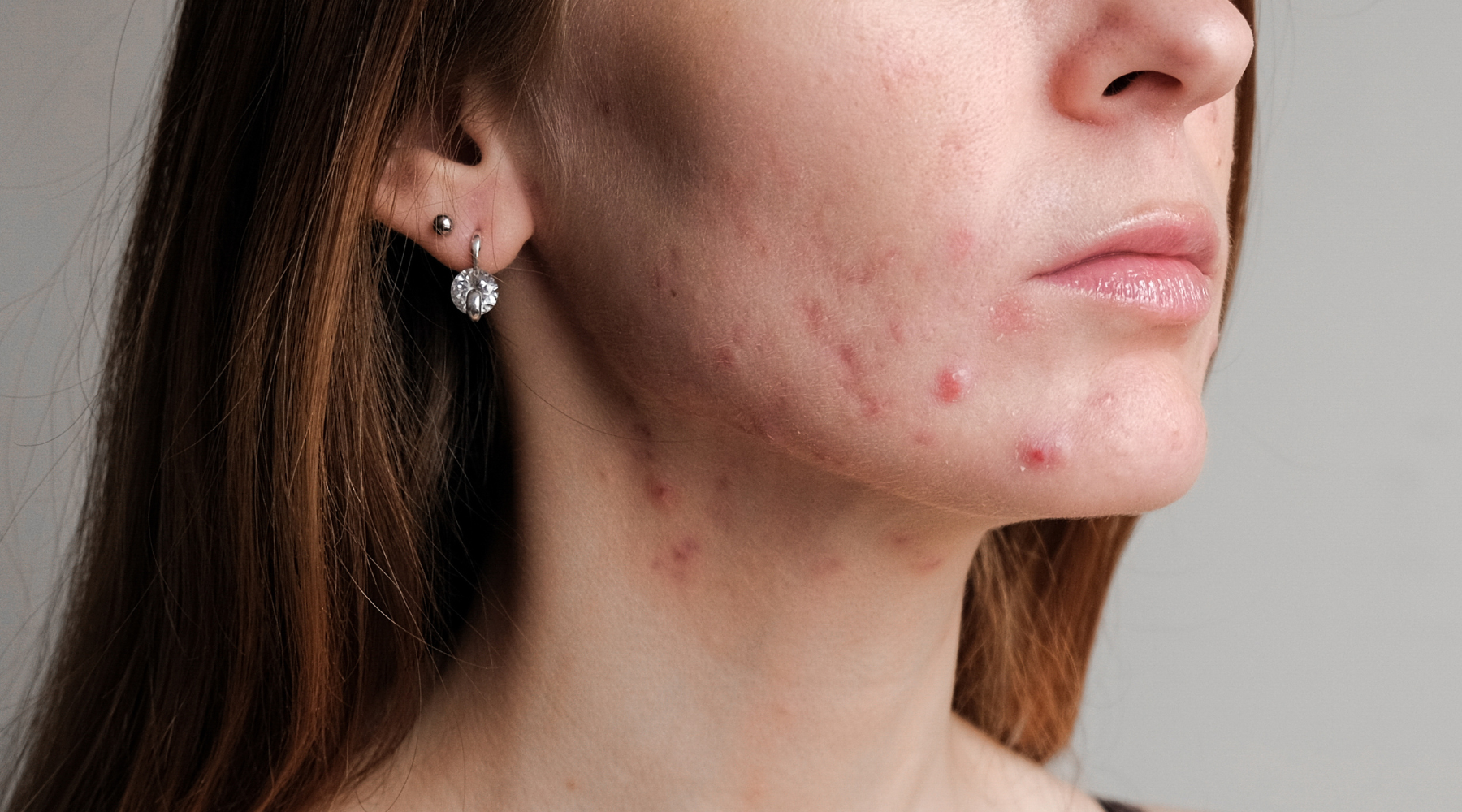 How to Fix Uneven Skin Tone: Solutions for Splotchy, Imperfect Skin