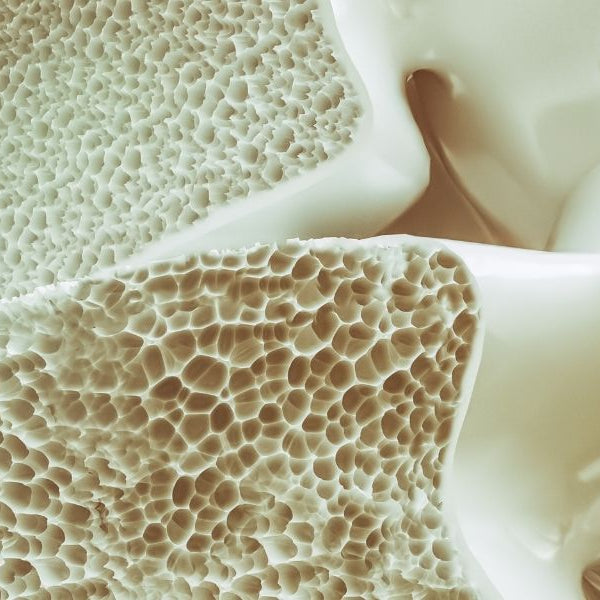 bombshell causes of osteoporosis